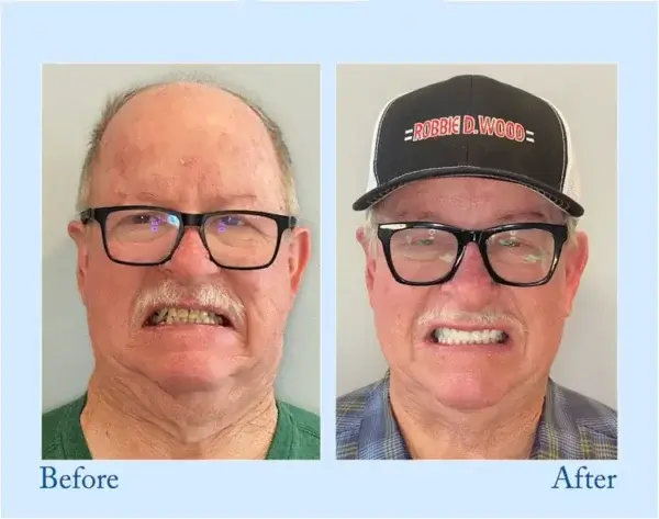 NESLEMY™ Custom-Fit Functional Dentures – Perfectly Fitted in Minutes at Home